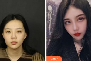 北海韓美醫(yī)療美容門(mén)診部楊雙輝整形價(jià)格表附埋線雙眼皮案例展示