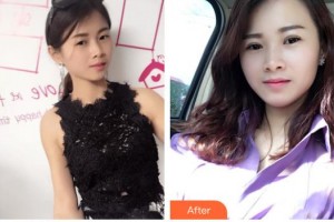 欽州市第二人民醫(yī)院眼科李艷春整形價格表附激光去眼袋案例展示