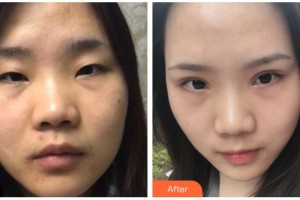 貴港市人民醫(yī)院燒傷整形外科邊建民整形價格表附眼部綜合案例展示