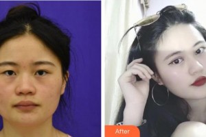 貴港市人民醫(yī)院燒傷整形外科黃運嚴整形價格表附切開雙眼皮案例展示