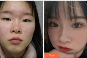 貴港愛爾眼科醫(yī)院唐健青整形價格表附眼部綜合案例展示