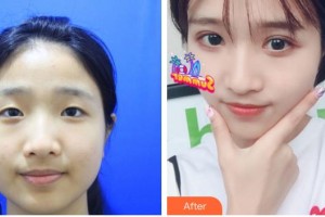 貴港愛爾眼科醫(yī)院吳香蓮整形價格表附眼部綜合案例展示