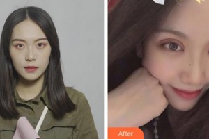 貴港愛爾眼科醫(yī)院梁岸整形價格表附眼部綜合案例展示