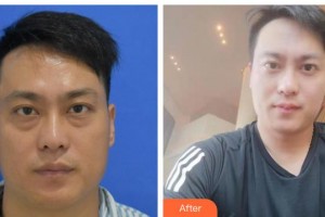 貴港愛爾眼科醫(yī)院胡美霞整形價格表附激光去眼袋案例展示