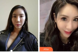 貴港愛爾眼科醫(yī)院潘可生整形價格表附切開雙眼皮案例展示