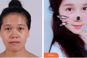 貴港愛爾眼科醫(yī)院馮桂強整形價格表附眼部修復(fù)案例展示