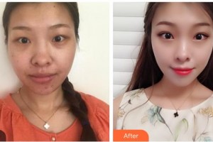 玉林華美整形美容醫(yī)院劉慧整形價(jià)格表附眼部綜合案例展示