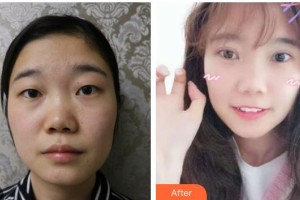 玉林愛爾眼科醫(yī)院李平整形價(jià)格表附切開雙眼皮案例展示