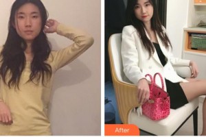 玉林市皮膚病防治醫(yī)院美容外科盧祖初整形價(jià)格表附玻尿酸精華導(dǎo)入案例展示