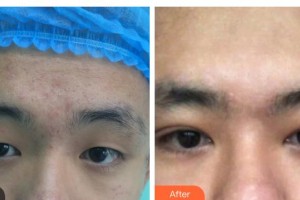 玉林愛爾眼科醫(yī)院羅志紅整形價(jià)格表附開內(nèi)眼角案例展示