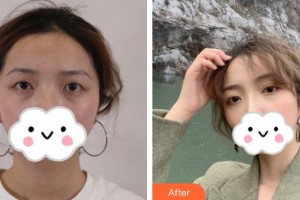 河池市中醫(yī)醫(yī)院眼科任武鵬整形價(jià)格表附切開雙眼皮案例展示