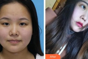 來賓市興賓區(qū)人民醫(yī)院眼科陳海軍整形價(jià)格表附眼部綜合案例展示