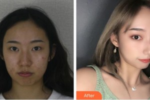 來賓市人民醫(yī)院眼科張鵬整形價(jià)格表附眼部綜合案例展示