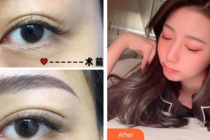 海南瑞韓醫(yī)學(xué)美容醫(yī)院徐春梅整形價格表附埋線雙眼皮案例展示