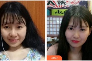 海南眼科醫(yī)院陳海波整形價格表附切開雙眼皮案例展示