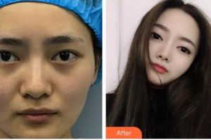 海南眼科醫(yī)院張秀蘭整形價格表附眼部修復(fù)案例展示