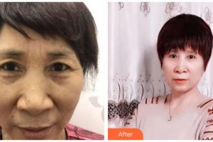 海南眼科醫(yī)院曾明兵整形價格表附切眉術(shù)案例展示