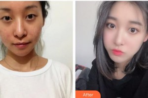 海南眼視光學(xué)中心門診部李加青整形價格表附開內(nèi)眼角案例展示