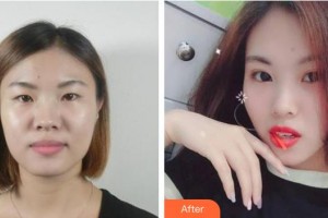 海南眼視光學(xué)中心門診部劉春民整形價格表附切開雙眼皮案例展示