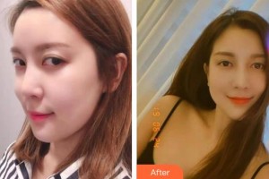 海南眼科醫(yī)院冼文光整形價格表附眼部修復(fù)案例展示