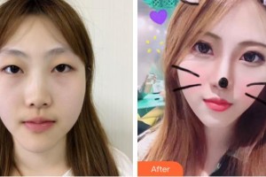 海南省中醫(yī)院眼科中心何瓊敏住院醫(yī)師整形價格表附眼部綜合案例展示