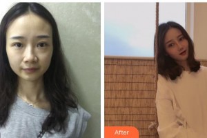 海南眼視光學(xué)中心門診部梁瓊整形價格表附切開雙眼皮案例展示