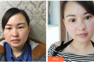 海南眼科醫(yī)院史貽玉整形價格表附切開雙眼皮案例展示