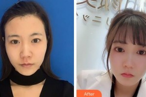 ?？跂|湖醫(yī)學(xué)美容整形醫(yī)院張文其整形價(jià)格表附去痘印痘坑案例展示