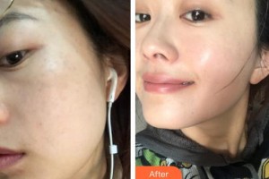 ?？邬i愛(ài)醫(yī)療美容醫(yī)院任秀麗整形價(jià)格表附激光祛斑案例展示