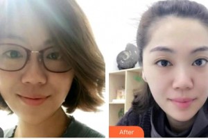 ?？诖揸匚尼t(yī)療美容診所崔曦文整形價(jià)格表附光子嫩膚案例展示