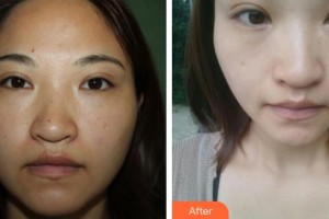 ?？谑械谒娜嗣襻t(yī)院眼科鐘羽麗整形價(jià)格表附清潔祛痘案例展示