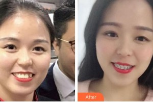 ?？诤佳谰S信口腔門(mén)診部李娜住院醫(yī)師整形價(jià)格表附自鎖托槽矯正案例展示