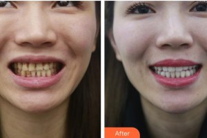 ?？诤佳谰S信口腔門(mén)診部吳惠強(qiáng)整形價(jià)格表附美白貼片案例展示