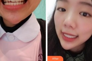 ?？诤佳谰S信口腔門(mén)診部樸光裕整形價(jià)格表附隱形托槽矯正案例展示