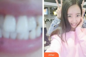 ?？诤佳谰S信口腔門(mén)診部楊惦山整形價(jià)格表附牙齒隱形矯正案例展示