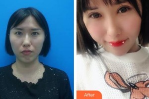 海口紅妝尚醫(yī)療美容門(mén)診部羅勇整形價(jià)格表附內(nèi)切祛眼袋案例展示