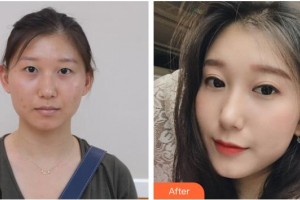 ?？诩t妝尚醫(yī)療美容門(mén)診部袁兆周整形價(jià)格表附切開(kāi)雙眼皮案例展示
