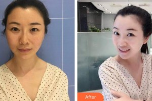 ?？诩t妝尚醫(yī)療美容門(mén)診部李楠整形價(jià)格表附埋線提升案例展示