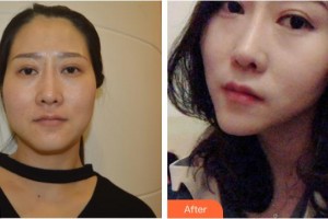 黃石美亞醫(yī)療美容門診部王幼明整形價(jià)格表附激光美膚激光案例展示