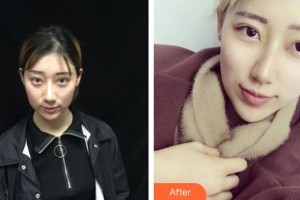 黃石華中?？滇t(yī)院（華中.華美）余秋芬整形價(jià)格表附埋線提升案例展示