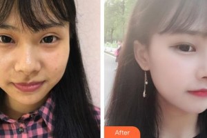 黃石愛爾眼科醫(yī)院田永宏整形價(jià)格表附埋線雙眼皮案例展示