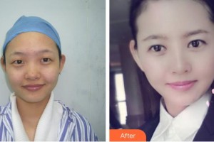 黃石愛爾眼科醫(yī)院程國(guó)旺整形價(jià)格表附眼部綜合案例展示