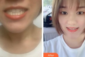 黃石春天口腔門診部馮懷玉整形價(jià)格表附牙齒隱形矯正案例展示