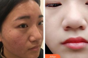 襄陽(yáng)韓美醫(yī)療美容醫(yī)院王娜整形價(jià)格表附去痘印痘坑案例展示