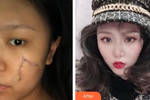 襄陽(yáng)市中心醫(yī)院整形美容科謝群整形價(jià)格表附激光祛疤案例展示