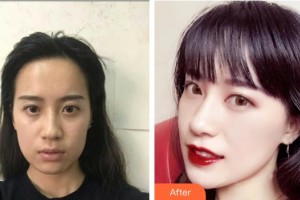 襄陽(yáng)市中心醫(yī)院整形美容科靳軍華整形價(jià)格表附無針?biāo)獍咐故?>
</a>
<h3 class=