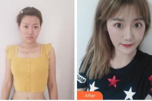 襄陽(yáng)海峽醫(yī)療美容門診部吳新建整形價(jià)格表附激光祛疤案例展示