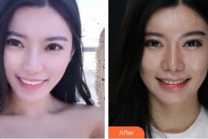 襄陽(yáng)華美醫(yī)療美容門診部李繼銀整形價(jià)格表附鼻部綜合案例展示