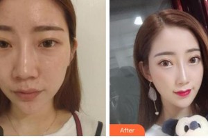 襄陽(yáng)維多利亞醫(yī)療美容醫(yī)院洪星杓整形價(jià)格表附鼻部綜合案例展示