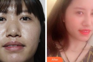 襄陽(yáng)華美醫(yī)療美容門診部段麗萍整形價(jià)格表附鼻部綜合案例展示